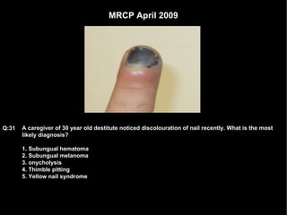 MRCP April 2009 A caregiver of 30 year old destitute noticed discolouration of nail recently. What is the most likely diagnosis? 1. Subungual hematoma 2. Subungual melanoma 3. onycholysis 4. Thimble pitting 5. Yellow nail syndrome Q:31 