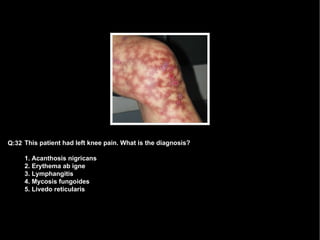 This patient had left knee pain. What is the diagnosis? 1. Acanthosis nigricans 2. Erythema ab igne 3. Lymphangitis  4. Mycosis fungoides 5. Livedo reticularis Q:32 