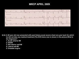 MRCP APRIL 2009 A 40 year old man presented with past history acute severe chest one year back for which he did not take any medical treatment.The ECG done now is shown in the picture.What is the diagnosis? 1. Acute anterior MI 2. HOCM 3. Old inferior wall MI 4. Lateral wall MI 5. Unstable angina Q:34 