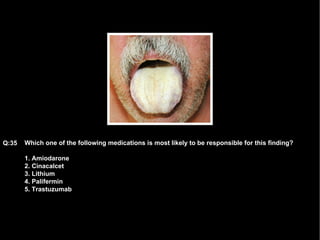 Which one of the following medications is most likely to be responsible for this finding? 1. Amiodarone 2. Cinacalcet 3. Lithium 4. Palifermin 5. Trastuzumab Q:35 