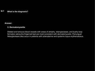 Answer: What is the diagnosis?   Q:1 2. Dermatomyositis Dilated and tortuous blood vessels with areas of atrophy, telangiectases, and bushy loop formation along the fingernail bed are most consistent with dermatomyositis. Periungual telangiectases also occur in patients with scleroderma and systemic lupus erythematosus.  