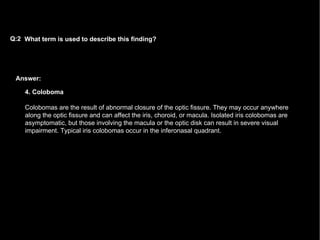 Answer: What term is used to describe this finding?  Q:2 4. Coloboma Colobomas are the result of abnormal closure of the optic fissure. They may occur anywhere along the optic fissure and can affect the iris, choroid, or macula. Isolated iris colobomas are asymptomatic, but those involving the macula or the optic disk can result in severe visual impairment. Typical iris colobomas occur in the inferonasal quadrant.  