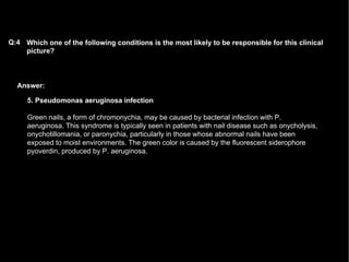 Answer: Which one of the following conditions is the most likely to be responsible for this clinical picture?   Q:4 5. Pseudomonas aeruginosa infection Green nails, a form of chromonychia, may be caused by bacterial infection with P. aeruginosa. This syndrome is typically seen in patients with nail disease such as onycholysis, onychotillomania, or paronychia, particularly in those whose abnormal nails have been exposed to moist environments. The green color is caused by the fluorescent siderophore pyoverdin, produced by P. aeruginosa. 