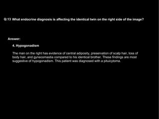 Answer: What endocrine diagnosis is affecting the identical twin on the right side of the image?   Q:13 4. Hypogonadism The man on the right has evidence of central adiposity, preservation of scalp hair, loss of body hair, and gynecomastia compared to his identical brother. These findings are most suggestive of hypogonadism. This patient was diagnosed with a pituicytoma.  