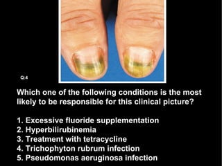 Which one of the following conditions is the most likely to be responsible for this clinical picture? 1. Excessive fluoride supplementation 2. Hyperbilirubinemia 3. Treatment with tetracycline 4. Trichophyton rubrum infection 5. Pseudomonas aeruginosa infection Q:4 