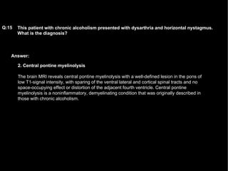 Answer: This patient with chronic alcoholism presented with dysarthria and horizontal nystagmus. What is the diagnosis?   Q:15 2. Central pontine myelinolysis The brain MRI reveals central pontine myelinolysis with a well-defined lesion in the pons of low T1-signal intensity, with sparing of the ventral lateral and cortical spinal tracts and no space-occupying effect or distortion of the adjacent fourth ventricle. Central pontine myelinolysis is a noninflammatory, demyelinating condition that was originally described in those with chronic alcoholism.  