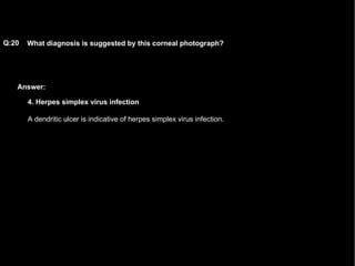 Answer: What diagnosis is suggested by this corneal photograph?   Q:20 4. Herpes simplex virus infection A dendritic ulcer is indicative of herpes simplex virus infection.  