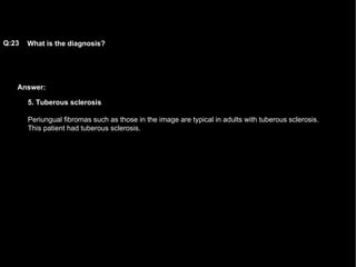 Answer: What is the diagnosis?   Q:23 5. Tuberous sclerosis Periungual fibromas such as those in the image are typical in adults with tuberous sclerosis. This patient had tuberous sclerosis. 