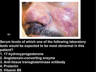 Serum levels of which one of the following laboratory tests would be expected to be most abnormal in this patient? 1. 17-hydroxyprogesterone 2. Angiotensin-converting enzyme 3. Anti-tissue transglutaminase antibody 4. Prolactin 5. Vitamin B6 Q5: 