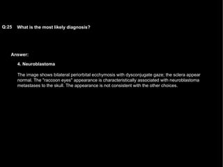 Answer: What is the most likely diagnosis?   Q:25 4. Neuroblastoma The image shows bilateral periorbital ecchymosis with dysconjugate gaze; the sclera appear normal. The "raccoon eyes" appearance is characteristically associated with neuroblastoma metastases to the skull. The appearance is not consistent with the other choices.  