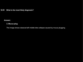 Answer: What is the most likely diagnosis?   Q:28 3. Mucus plug The image shows classical left middle lobe collapse caused by mucus plugging.  