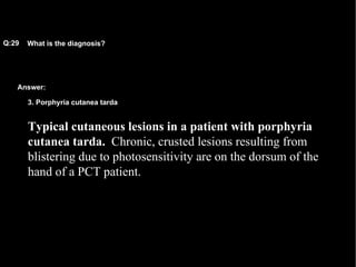 Answer: What is the diagnosis?   Q:29 3. Porphyria cutanea tarda Typical cutaneous lesions in a patient with porphyria cutanea tarda.   Chronic, crusted lesions resulting from blistering due to photosensitivity are on the dorsum of the hand of a PCT patient.  