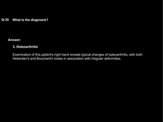 Answer: What is the diagnosis?   Q:30 3. Osteoarthritis Examination of this patient's right hand reveals typical changes of osteoarthritis, with both Heberden's and Bouchard's nodes in association with irregular deformities.  