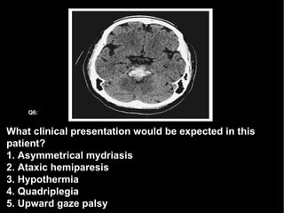 What clinical presentation would be expected in this patient? 1. Asymmetrical mydriasis  2. Ataxic hemiparesis 3. Hypothermia 4. Quadriplegia  5. Upward gaze palsy Q6: 