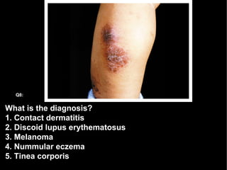 What is the diagnosis? 1. Contact dermatitis 2. Discoid lupus erythematosus 3. Melanoma 4. Nummular eczema 5. Tinea corporis Q8: 