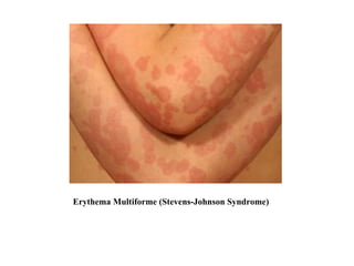 Erythema Multiforme (Stevens-Johnson Syndrome) 