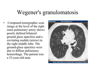 Wegener's granulomatosis Computed tomographic scan image at the level of the right main pulmonary artery shows poorly defined bilateral ground glass opacities and a cavitating nodule (arrow) in the right middle lobe. The ground-glass opacities were due to diffuse pulmonary hemorrhage. The patient was a 53-year-old man.  