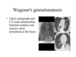Wegener's granulomatosis  Chest radiograph and CT scans demonstrate bilateral nodules and masses, most prominent at the bases  