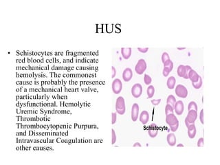 HUS  Schistocytes are fragmented red blood cells, and indicate mechanical damage causing hemolysis. The commonest cause is probably the presence of a mechanical heart valve, particularly when dysfunctional. Hemolytic Uremic Syndrome, Thrombotic Thrombocytopenic Purpura, and Disseminated Intravascular Coagulation are other causes.  