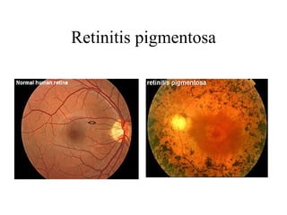 Retinitis pigmentosa                                         <>                                          <>  
