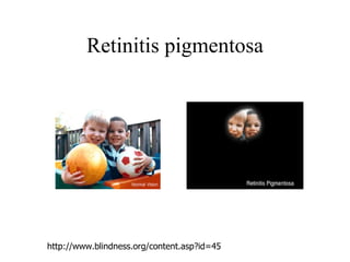 Retinitis pigmentosa http://www.blindness.org/content.asp?id=45 