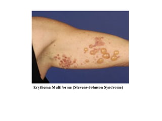 Erythema Multiforme (Stevens-Johnson Syndrome) 