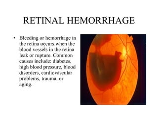 RETINAL HEMORRHAGE Bleeding or hemorrhage in the retina occurs when the blood vessels in the retina leak or rupture. Common causes include: diabetes, high blood pressure, blood disorders, cardiovascular problems, trauma, or aging.  