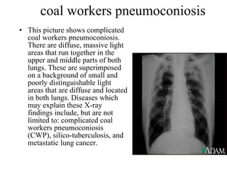 coal workers pneumoconiosis This picture shows complicated coal workers pneumoconiosis. There are diffuse, massive light areas that run together in the upper and middle parts of both lungs. These are superimposed on a background of small and poorly distinguishable light areas that are diffuse and located in both lungs. Diseases which may explain these X-ray findings include, but are not limited to: complicated coal workers pneumoconiosis (CWP), silico-tuberculosis, and metastatic lung cancer.  
