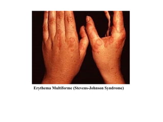 Erythema Multiforme (Stevens-Johnson Syndrome) 