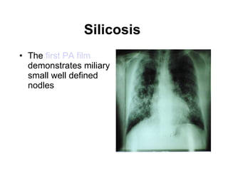 Silicosis   The  first PA film  demonstrates miliary small well defined nodles   
