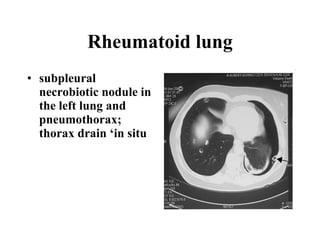 Rheumatoid lung subpleural necrobiotic nodule in the left lung and pneumothorax; thorax drain ‘in situ   