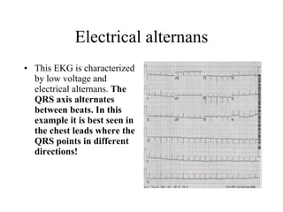 Electrical alternans This EKG is characterized by low voltage and electrical alternans.  The QRS axis alternates between beats. In this example it is best seen in the chest leads where the QRS points in different directions!  