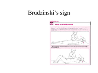 Brudzinski’s sign 