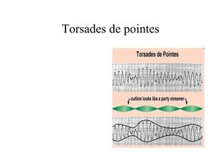 Torsades de pointes 