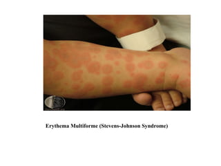 Erythema Multiforme (Stevens-Johnson Syndrome) 