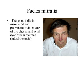 Facies mitralis    Facies mitralis  is associated with prominent livid colour of the cheeks and acral cyanosis in the face (mitral stenosis)  