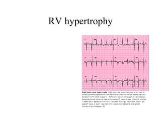 RV hypertrophy 