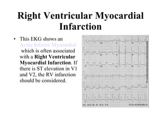 Right Ventricular Myocardial Infarction This EKG shows an  Acute Inferior Myocardial Infarction  which is often associated with a  Right Ventricular Myocardial Infarction . If there is ST elevation in V1 and V2, the RV infarction should be considered.  