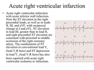 Acute right ventricular infarction Acute right ventricular infarction with acute inferior wall infarction. Note the ST elevation in the right precordial leads, as well as in leads II, III, and aVF, with reciprocal change in I and aVL. ST elevation in lead III, greater than in lead II, and right precordial ST elevation are consistent with proximal to middle occlusion of the right coronary artery. The combination of ST elevation in conventional lead V 1  (lead V 2 R here) and ST depression in lead V 2  (lead V 1 R here) has also been reported with acute right ventricular ischemia or infarction.  