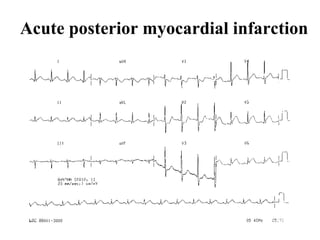 Acute posterior myocardial infarction 