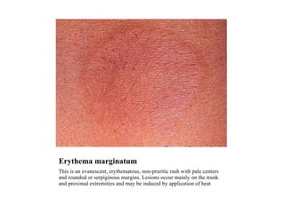 Erythema marginatum This is an evanescent, erythematous, non-pruritic rash with pale centers and rounded or serpiginous margins. Lesions occur mainly on the trunk and proximal extremities and may be induced by application of heat  