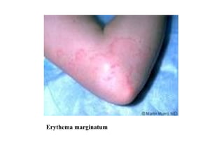 Erythema marginatum 