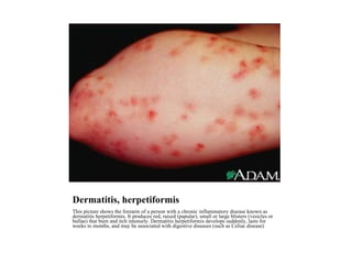 Dermatitis, herpetiformis This picture shows the forearm of a person with a chronic inflammatory disease known as dermatitis herpetiformis. It produces red, raised (papular), small or large blisters (vesicles or bullae) that burn and itch intensely. Dermatitis herpetiformis develops suddenly, lasts for weeks to months, and may be associated with digestive diseases (such as Celiac disease) 