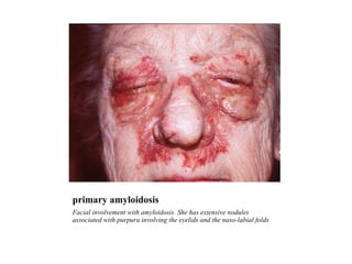 primary amyloidosis  Facial involvement with amyloidosis. She has extensive nodules associated with purpura involving the eyelids and the naso-labial folds 