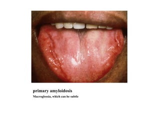 primary amyloidosis  Macroglossia, which can be subtle 