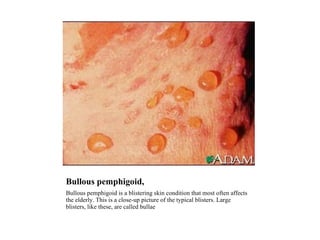 Bullous pemphigoid,  Bullous pemphigoid is a blistering skin condition that most often affects the elderly. This is a close-up picture of the typical blisters. Large blisters, like these, are called bullae 