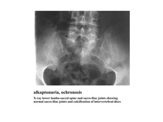 alkaptonuria, ochronosis X-ray lower lumbo-sacral spine and sacro-iliac joints showing normal sacro-iliac joints and calcification of intervertebral discs  