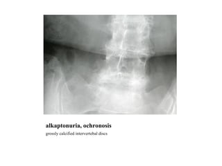 alkaptonuria, ochronosis grossly calcified intervertebal discs 