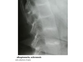 alkaptonuria, ochronosis early ankylosis of spine 