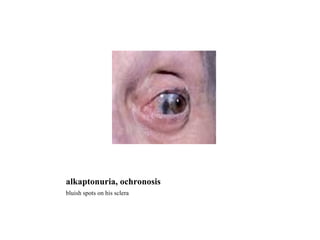 alkaptonuria, ochronosis bluish spots on his sclera 